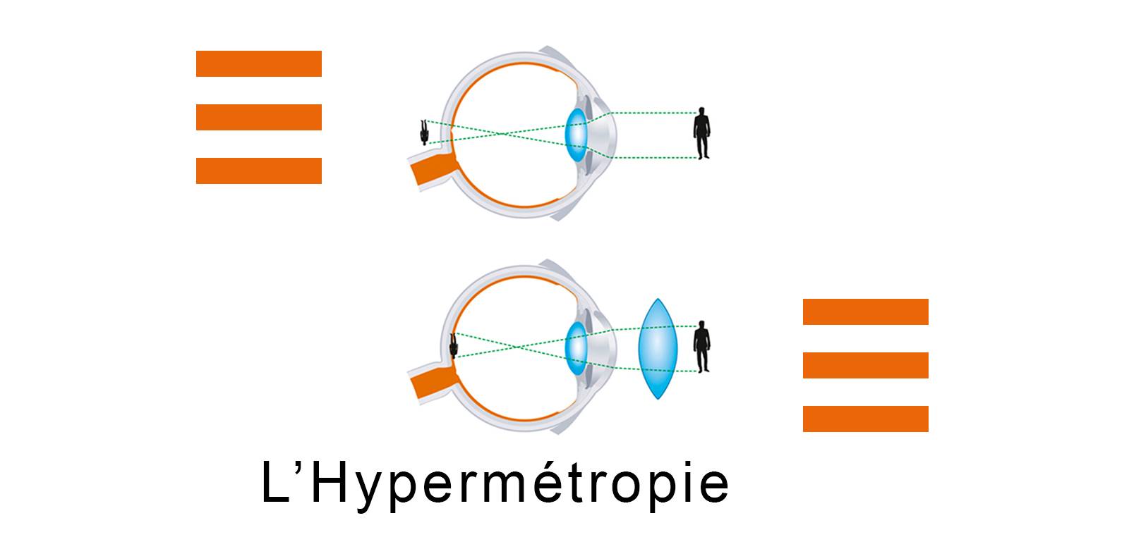 L'hypermétropie